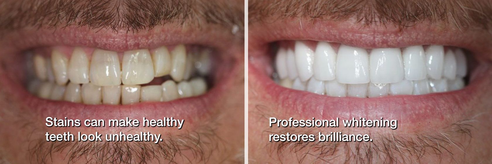 Before and after cosmetic dentistry
